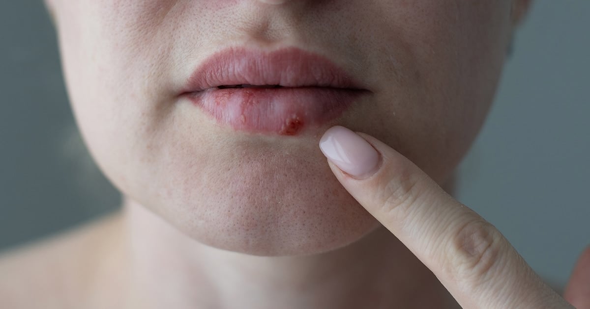 Después de casi treinta años, la FDA le dio luz verde a un antiviral oral pensado para los casos más difíciles de herpes simple