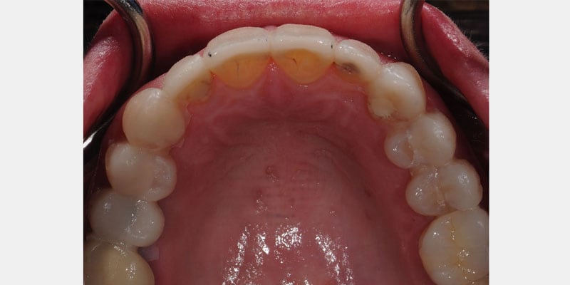Carillas dentales: qué ocurre cuando el cemento deja de sellar el diente